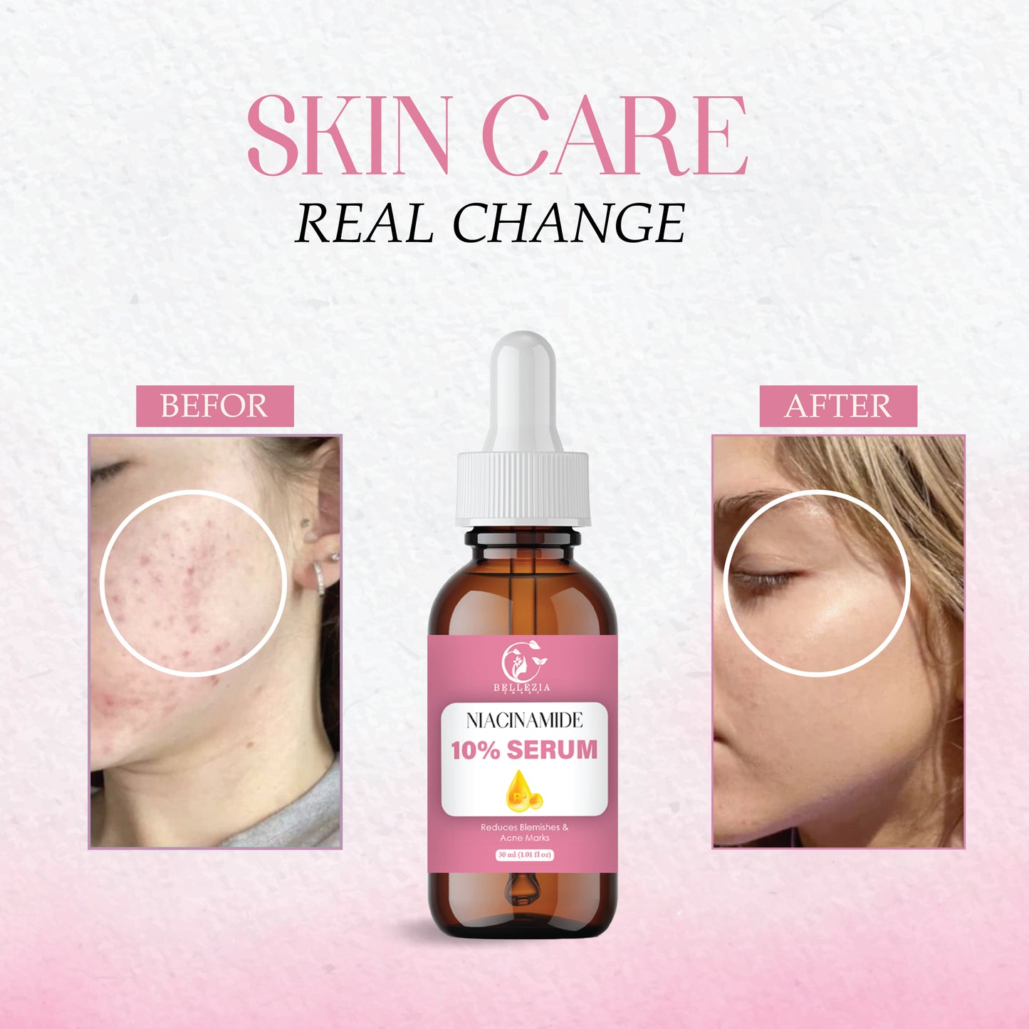 Niacinamide Face Serum for Acne Marks, Dark Spots & Oil Control | Skin Brightening & Pore Minimizing Serum | For Men & Women – 30ml